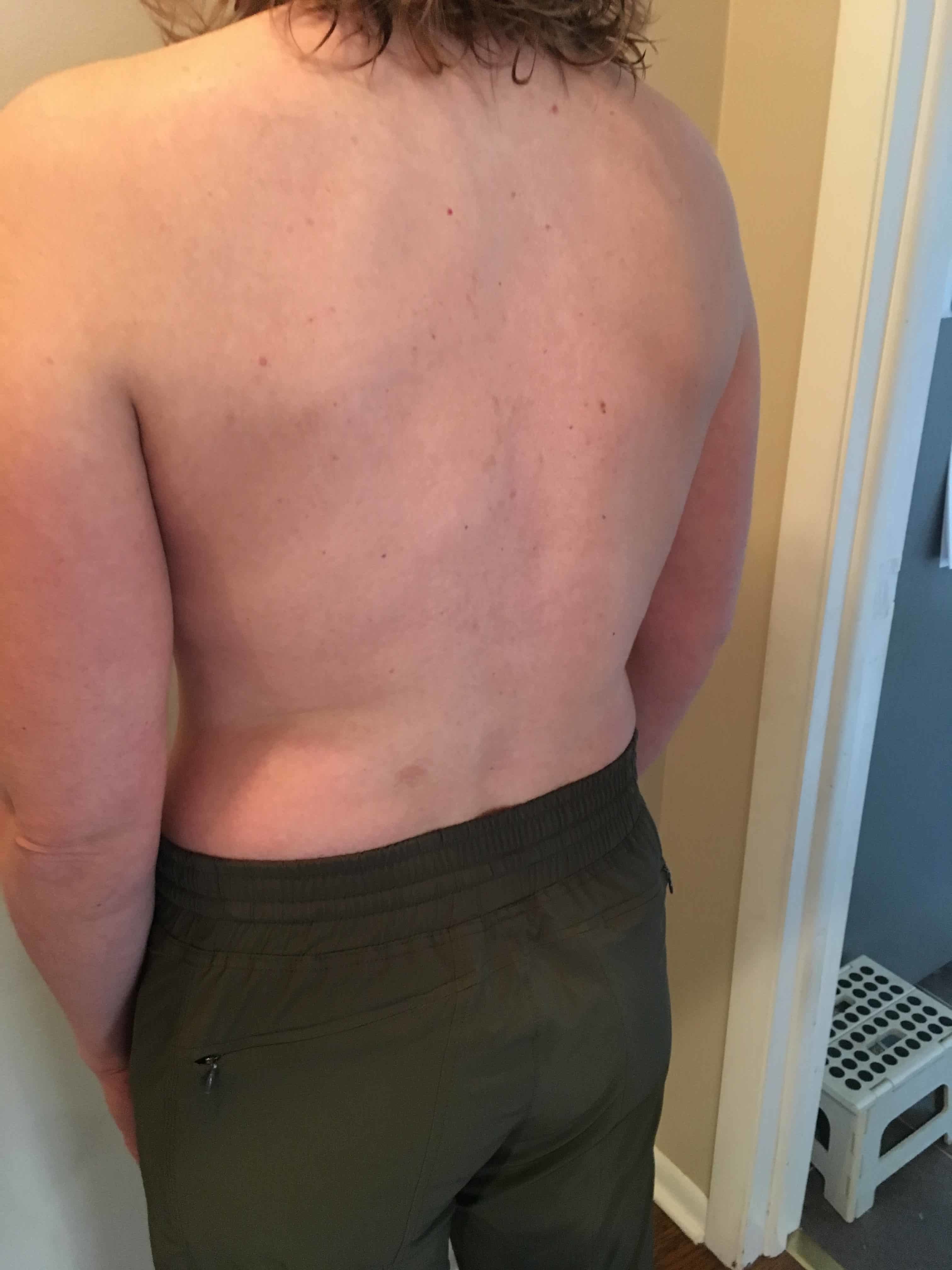Phil, Massage Therapist in Wayzata, MN, Restored My Quality of Life with Scoliosis!
